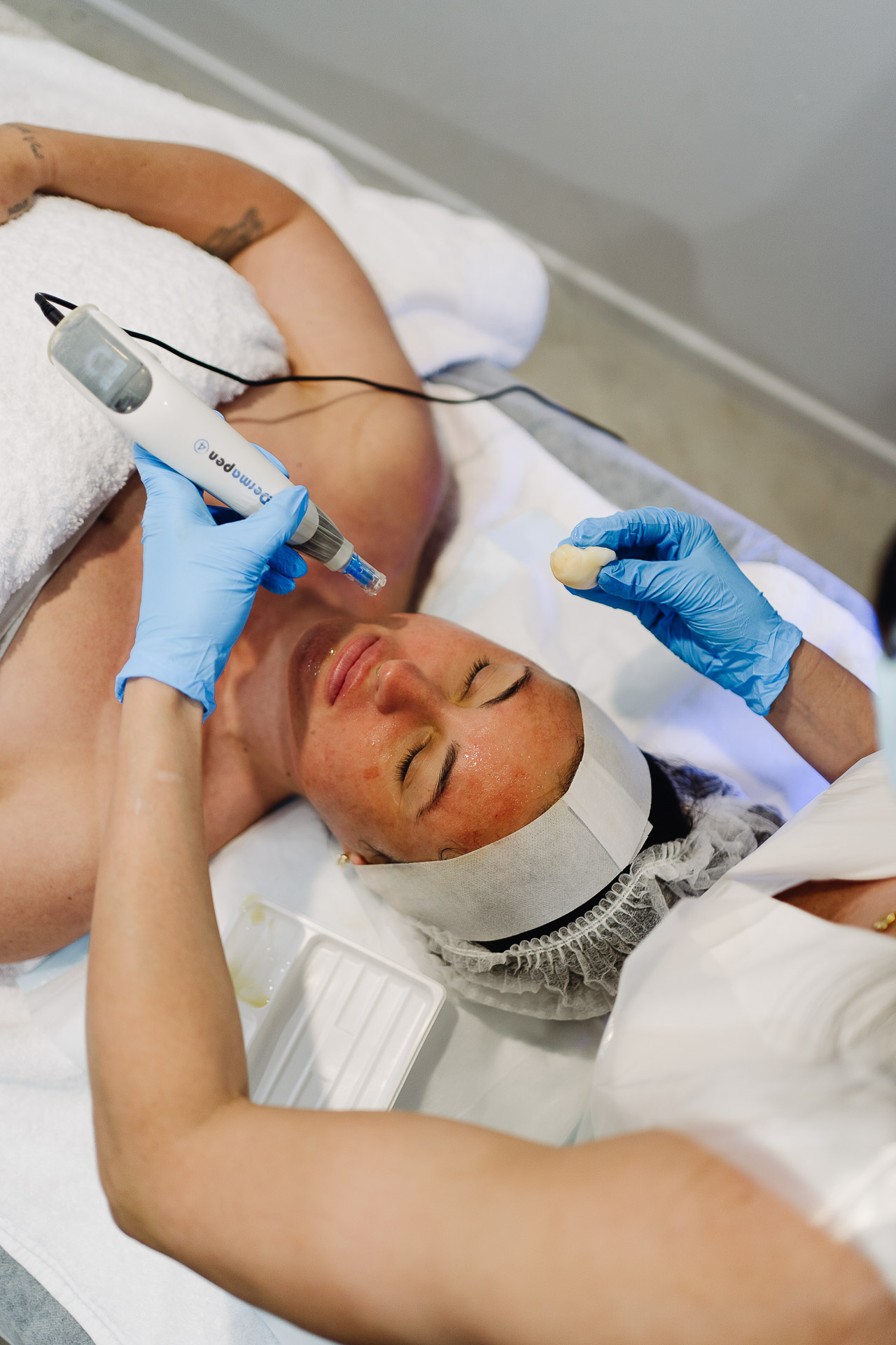 Micro Needling with Dermapen 4 - Dermapen Treatments can reduce the appearance of age and sun-related spots, soften lines and wrinkles, and thicken thinning, sagging skin, which are all part of the natural ageing process due to reduced collagen in the skin.